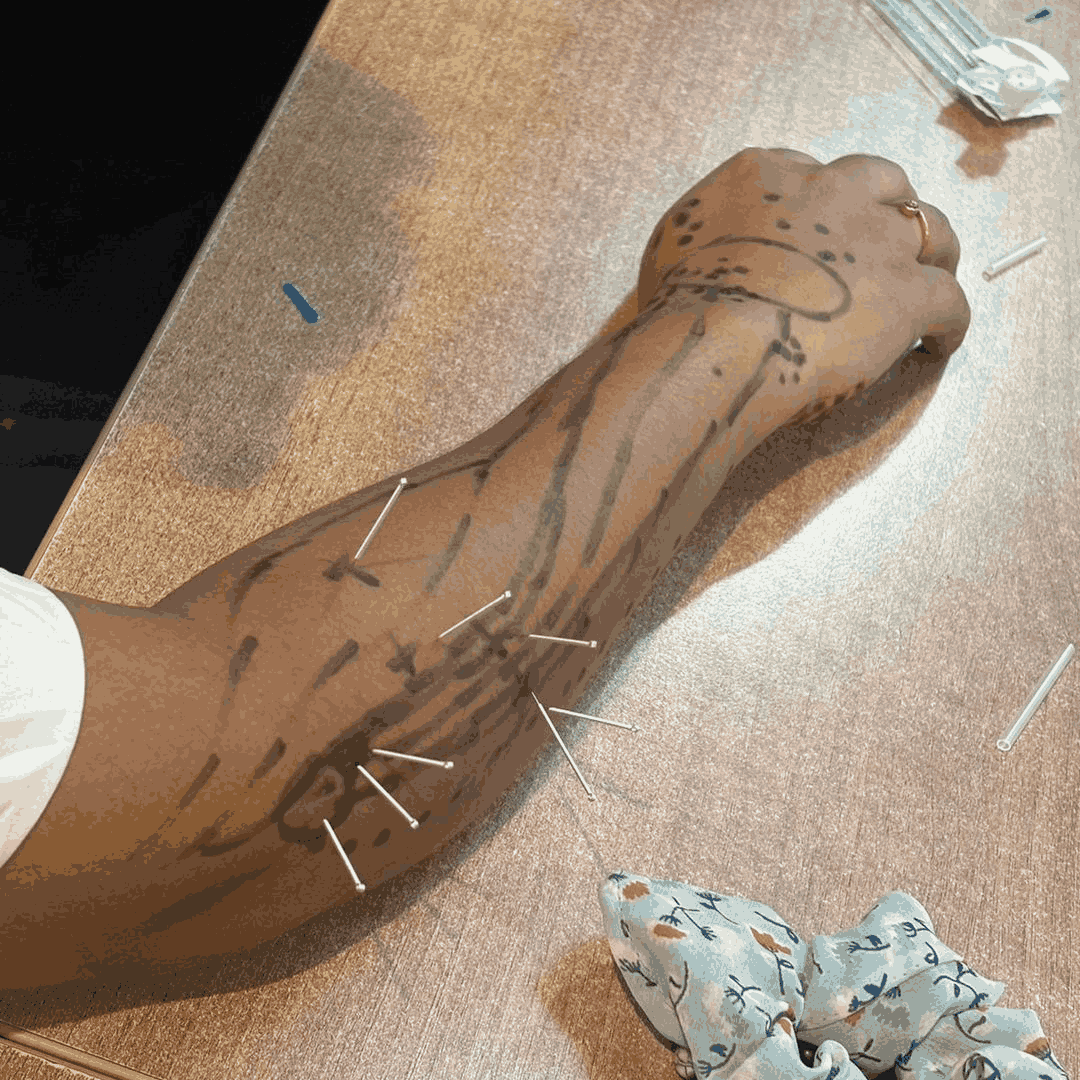 workshop-on-dry-needling (9)